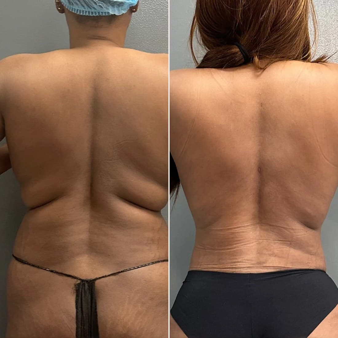 Awake Lipo 360 before and after, back view, patient 01