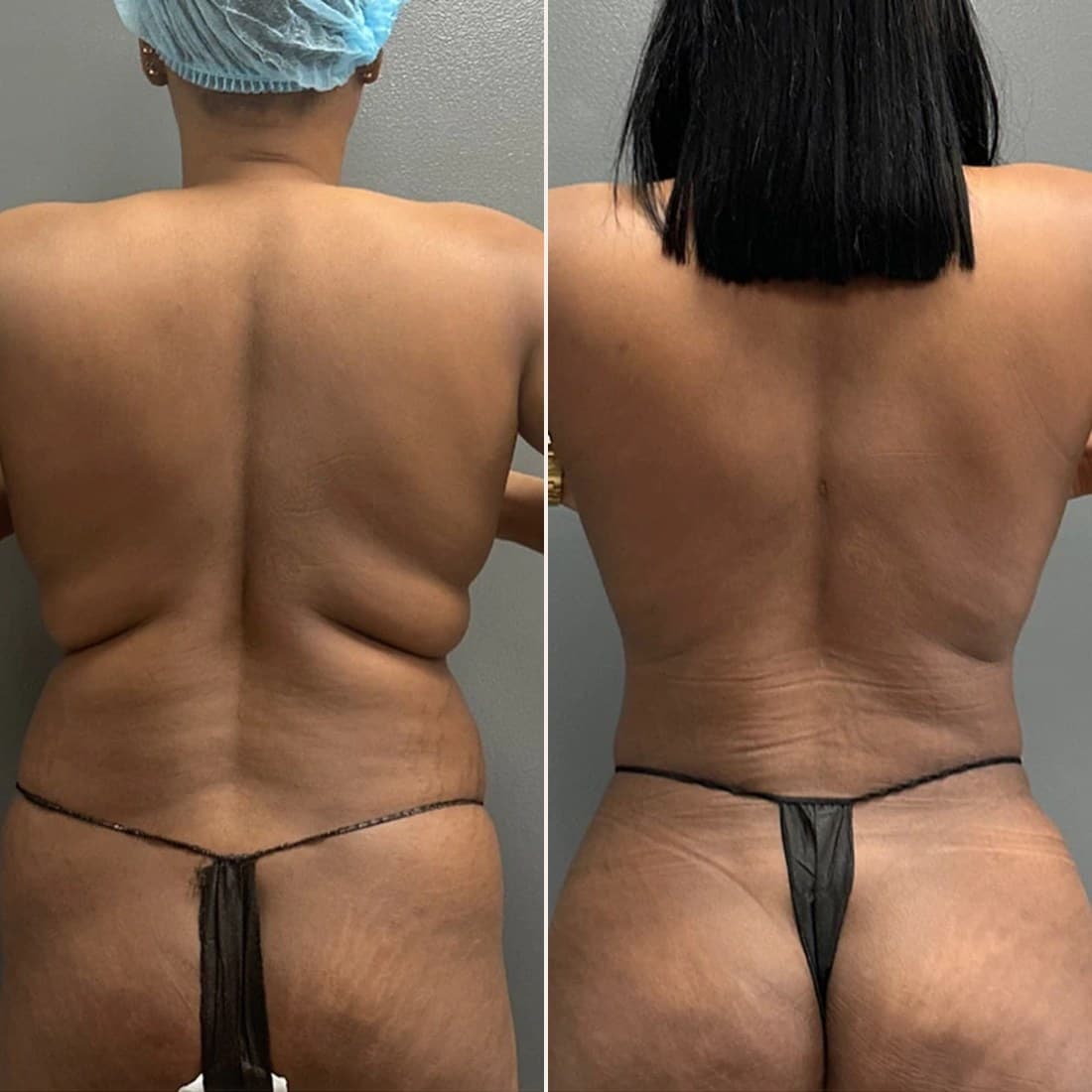 Awake Lipo 360 before and after, back view, patient 02