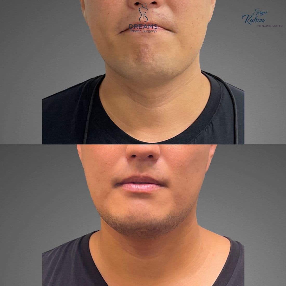 Chin Lipo before and after result