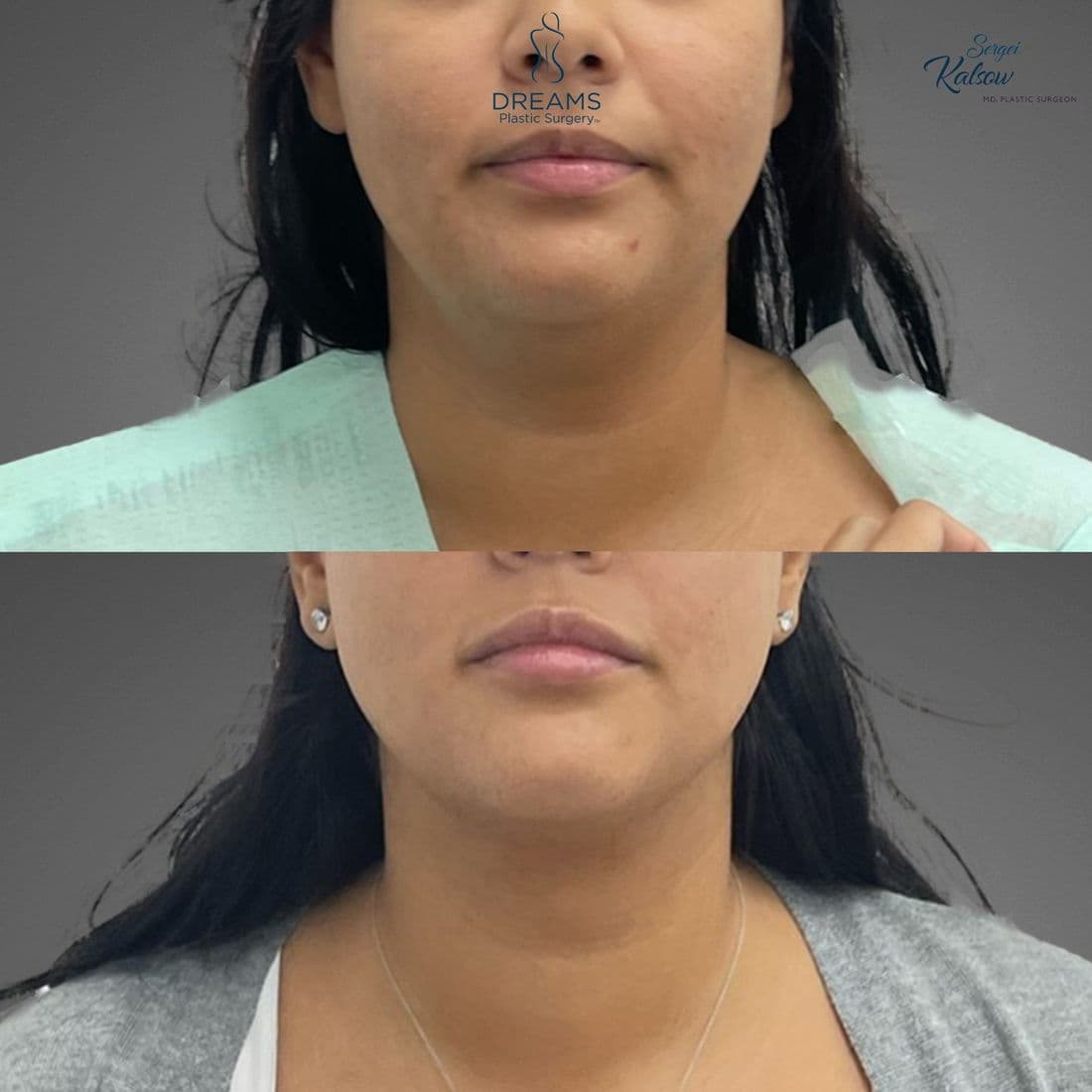 Chin liposuction before and after, front view