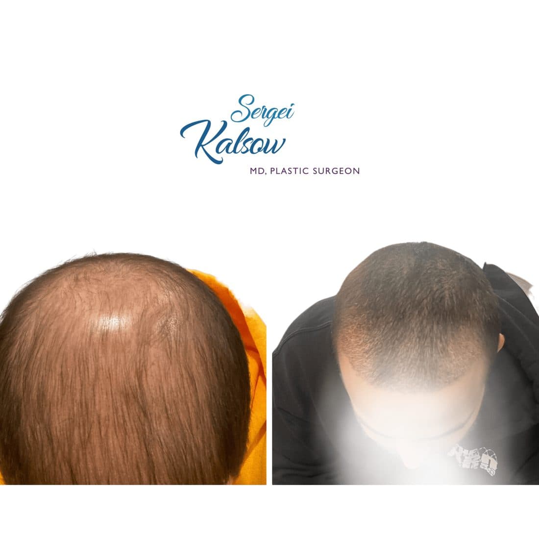 Hair Transplant before and after result