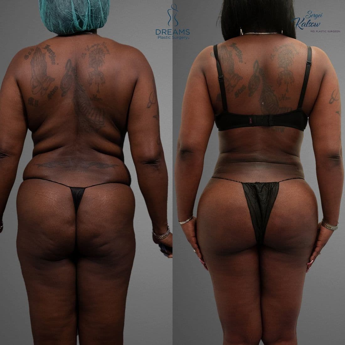 Lipo 360 + BBL before and after result