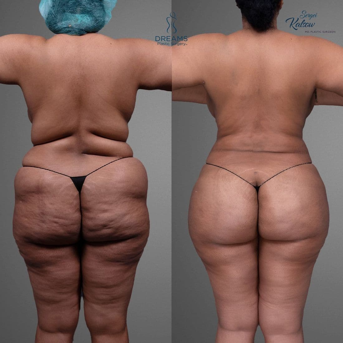 Lipo 360 and BBL before and after, back view