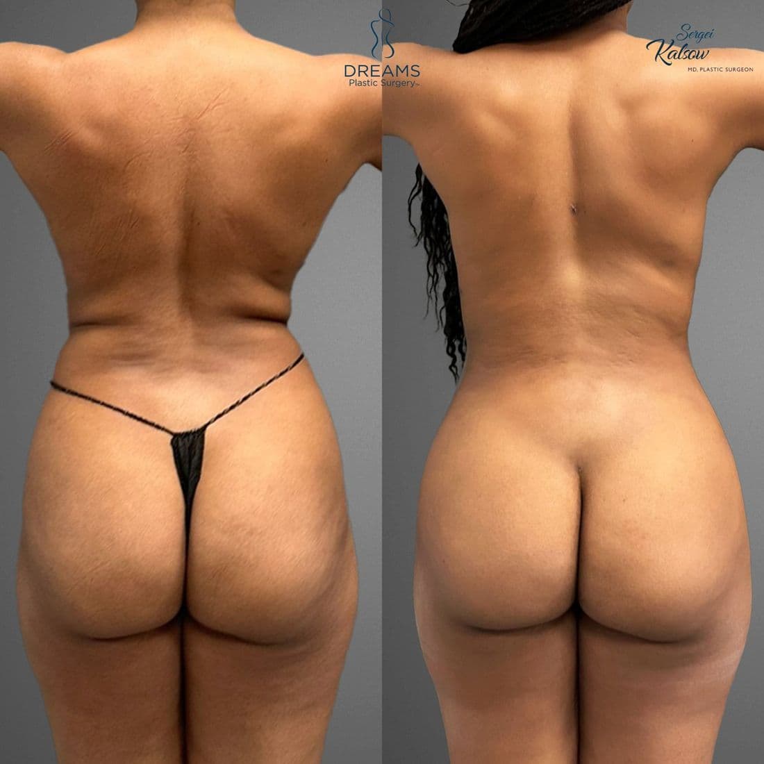 Skinny BBL before and after result
