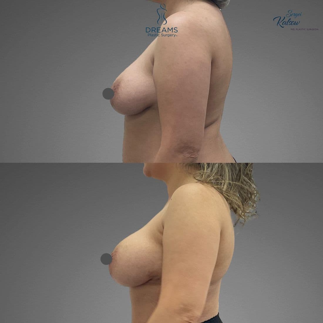 Awake fat transfer to breast before and after, profile view