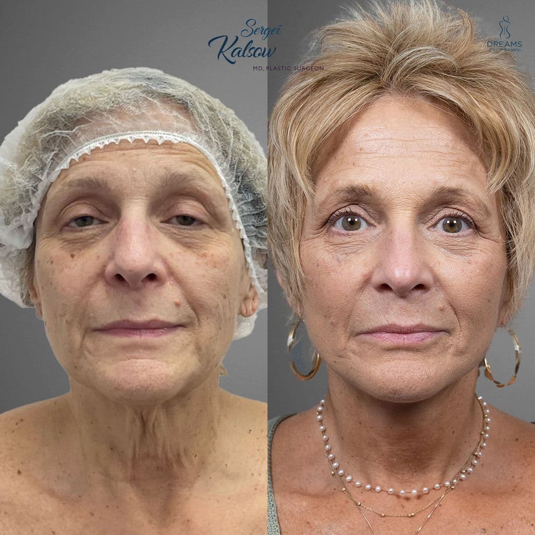 Facelift before and after, front view