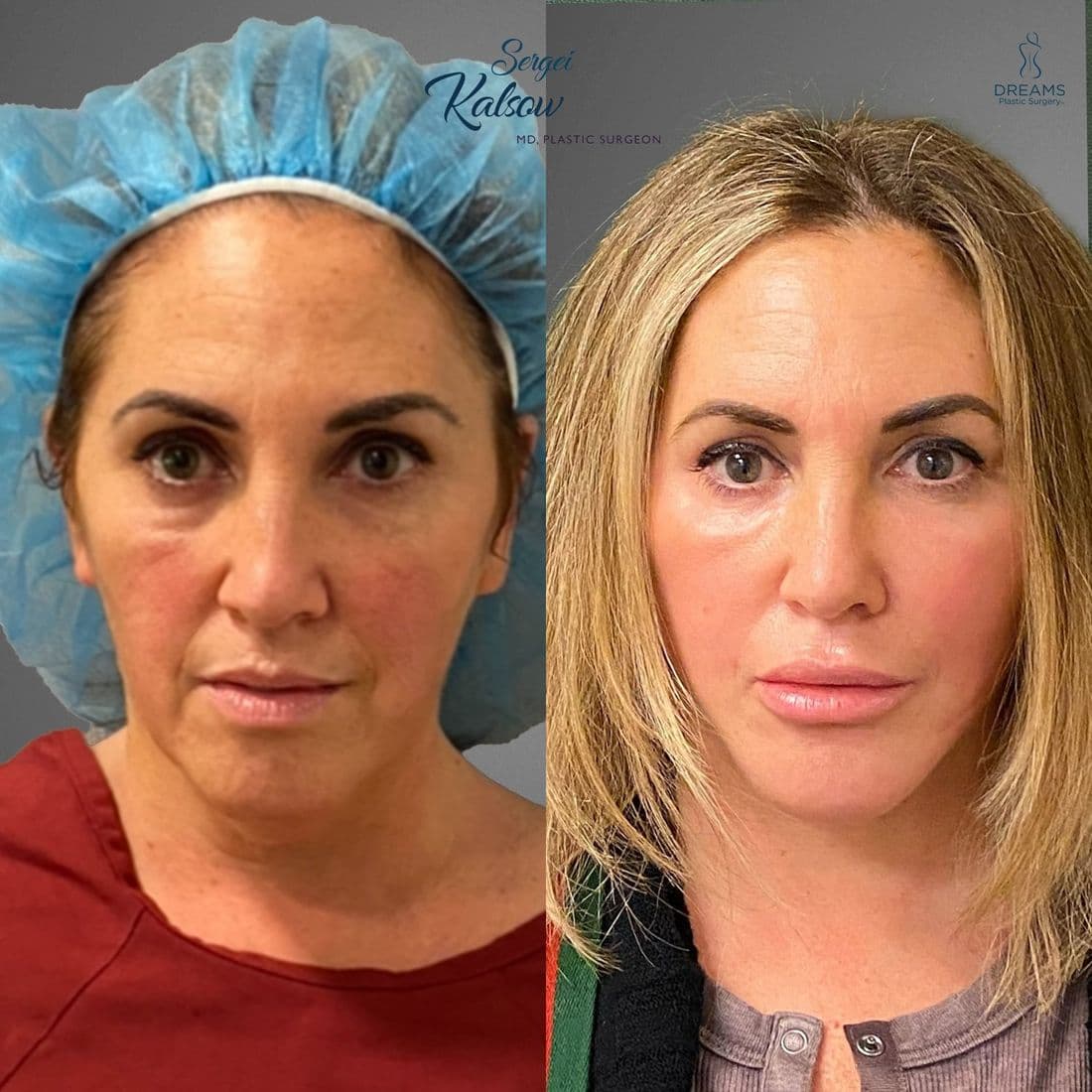 Facelift before and after, front view
