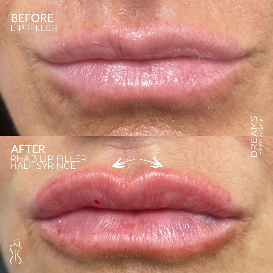 Lip augmentation before and after, close-up