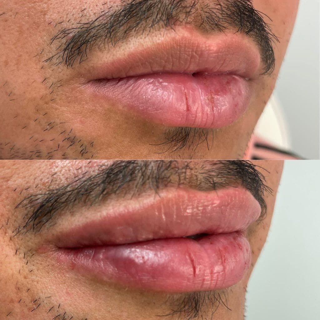 Lip augmentation before and after, close-up