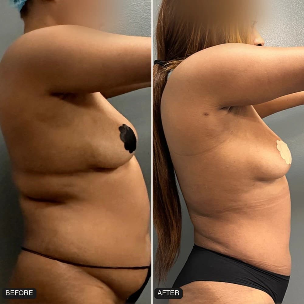 Awake Lipo 360 before and after, side view, patient case 01