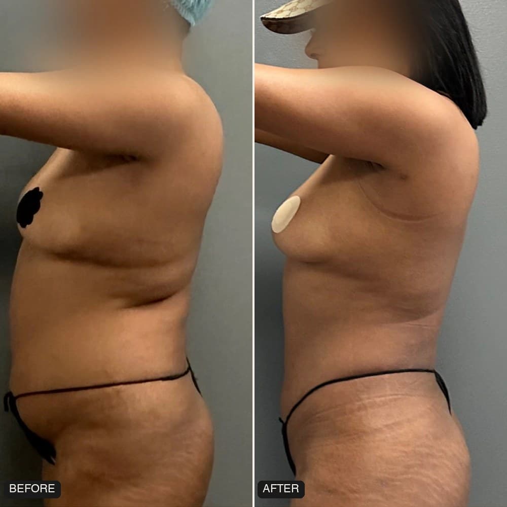 Awake Lipo 360 before and after, side view, patient case 02