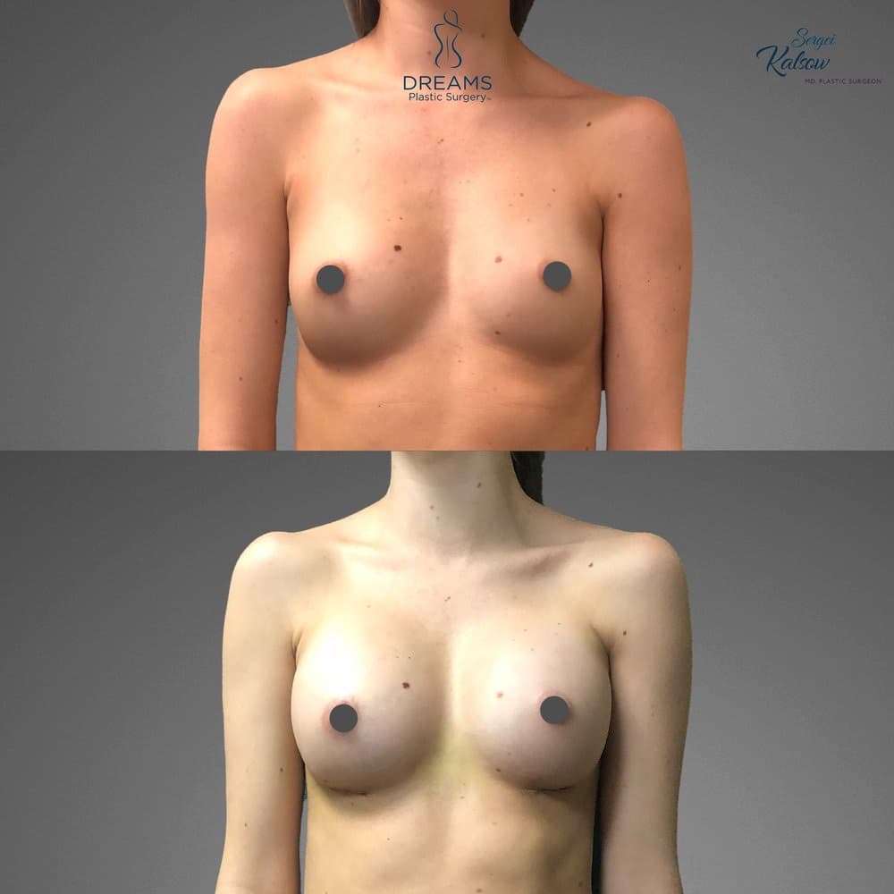 Breast Augmentation before-and-after result, patient case 02