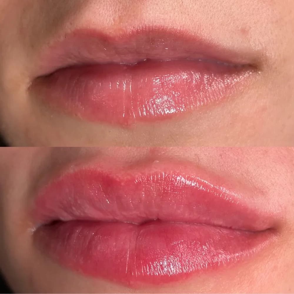 Lip Augmentation before-and-after result, patient case 01