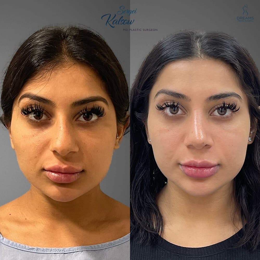 Rhinoplasty before-and-after result, patient case 02